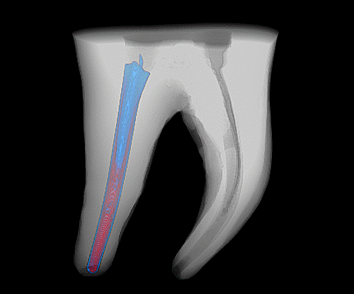 Wypełnienie w kanale zęba trzonowego